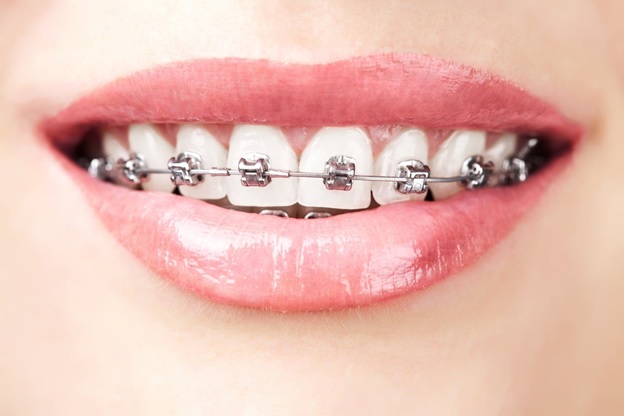 Teeth Straightening in Adults: Your Options for a Correct Smile